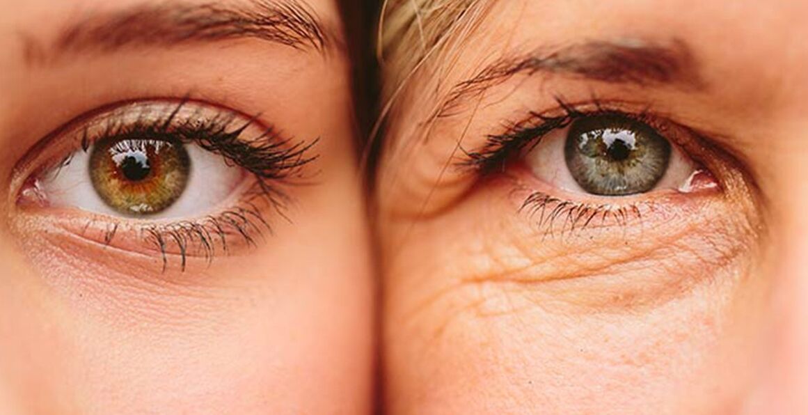 Signos externos de envejecimiento de la piel alrededor de los ojos de dos mujeres de diferentes edades