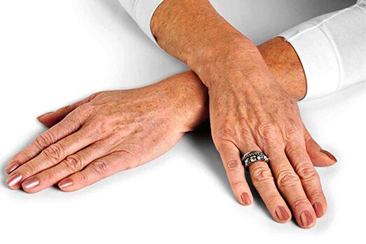 Los cambios en la piel de las manos relacionados con la edad requieren el uso de técnicas de rejuvenecimiento