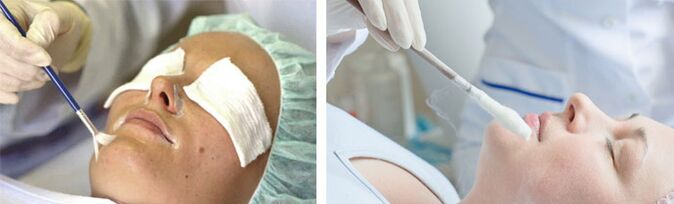 Peeling y crioterapia para el rejuvenecimiento de la piel