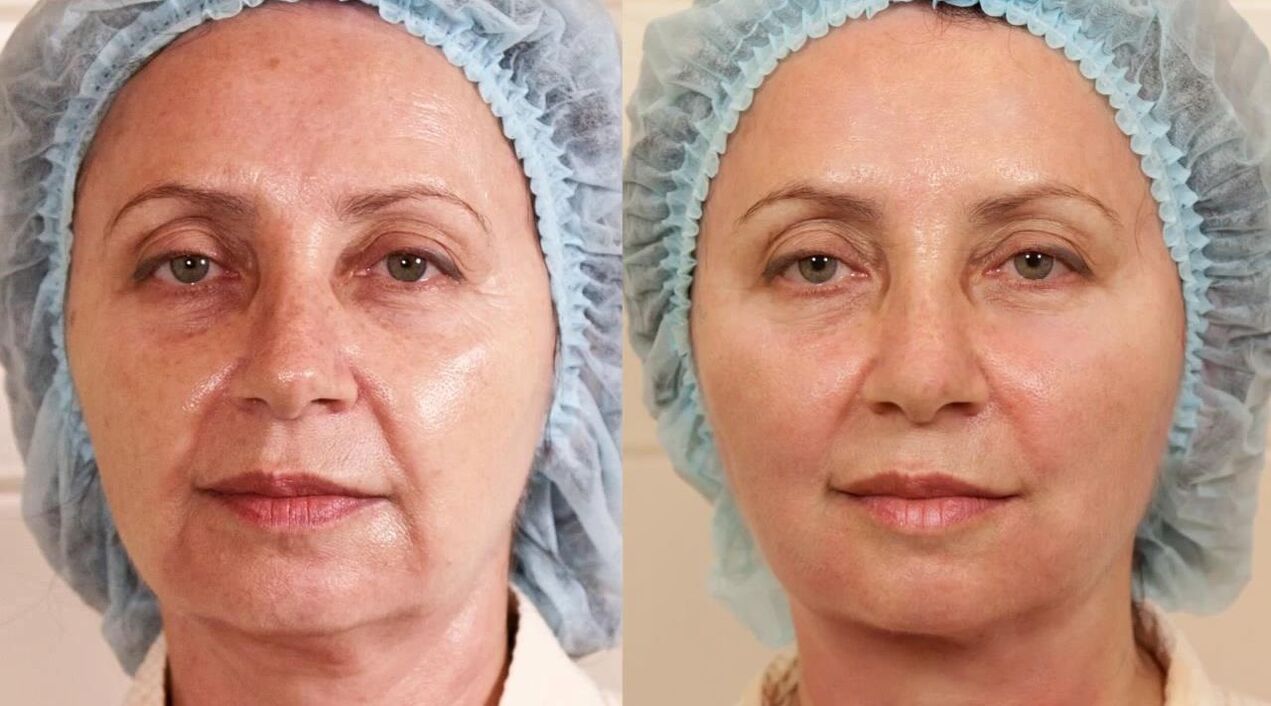 Fotos antes y después de la cirugía plástica. 