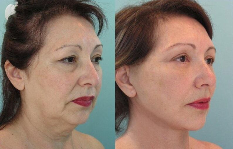 Utilice hilo reafirmante para la piel del rostro para obtener resultados rejuvenecedores