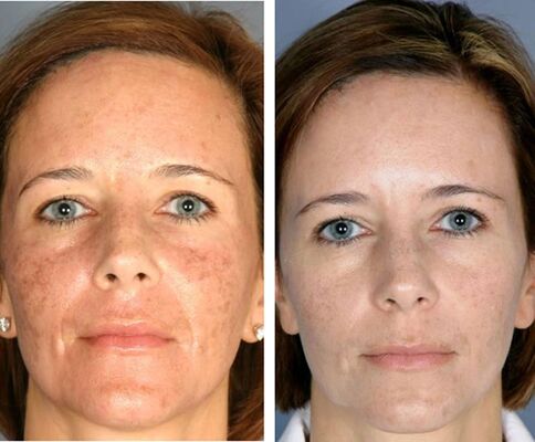 Antes y después de la pirólisis facial. 