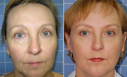 Antes y después de la reparación facial con láser fraccional