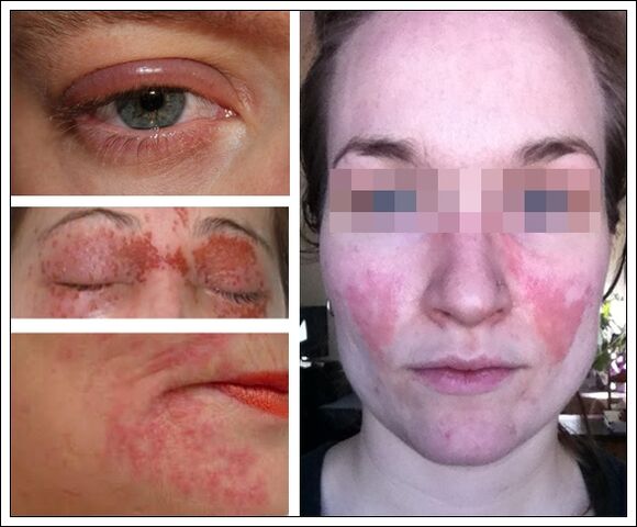 Alergia a la mascarilla anti-envejecimiento