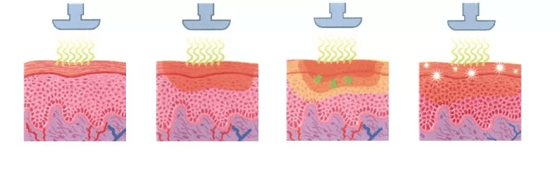 Cómo funciona el dispositivo de rejuvenecimiento de la piel en la piel
