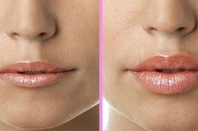 Antes y después de la cirugía de reparación de labios. 